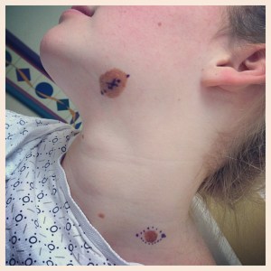 Surgeon marked her polka dots before surgery