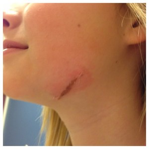 The after shot, it is red from the tape getting pulled off. This little bit that's left will come off on 3/7/13